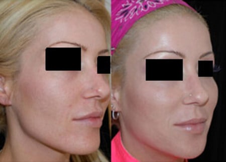 Dermal Filler Injections Boston Injectable Facial Fillers Boston