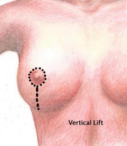 Vertical Mastopexy or Breast Lift with no scar underneath the breast