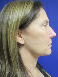Facelift Before and After Pictures Virginia Beach, VA