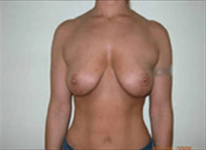 Breast Lift Before and After Pictures Virginia Beach, VA