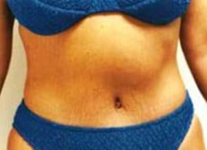 Tummy Tuck Before and After Pictures Virginia Beach, VA