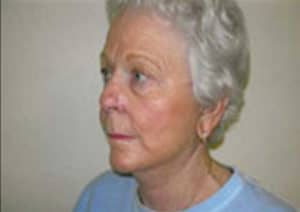 Facelift Before and After Pictures Virginia Beach, VA