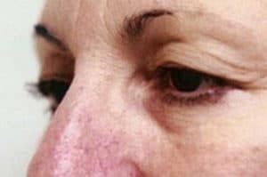 Blepharoplasty Before and After Pictures Virginia Beach, VA