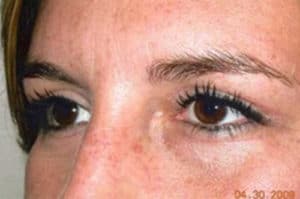 Blepharoplasty Before and After Pictures Virginia Beach, VA