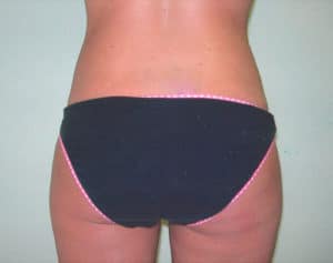 Liposuction Before and After Pictures Virginia Beach, VA