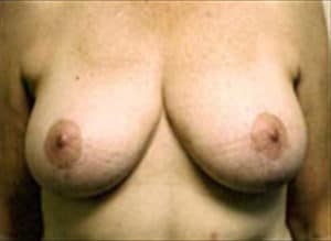 Breast Lift Before and After Pictures Virginia Beach, VA