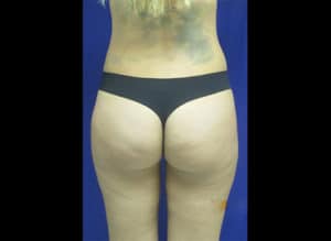 Liposuction Before and After Pictures Virginia Beach, VA