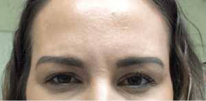 Botox® Before and After Pictures Virginia Beach, VA