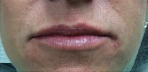 Lip Fillers Before and After Pictures Virginia Beach, VA