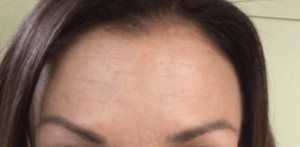 Botox® Before and After Pictures Virginia Beach, VA