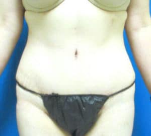 Tummy Tuck Before and After Pictures Virginia Beach, VA