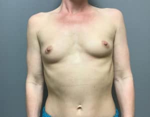 Breast Augmentation Before and After Pictures