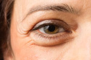 Eyelid Surgery Virginia Beach, VA
