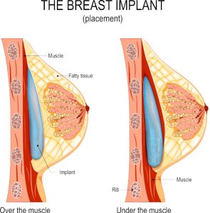 Breast Augmentation Virginia Beach