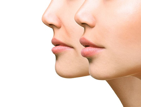 Lip Injections Virginia Beach - Lip Fillers Chesapeake & Norfolk, VA