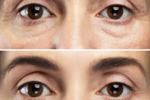 blepharoplasty results Virginia Beach
