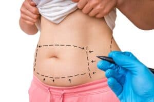 Tummy tuck in Miami