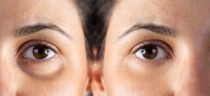 Eyelid surgery in Miami, FL
