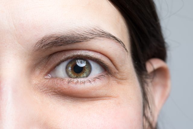 Close up of a woman's eye with drooping upper and lower eyelids before her eyelid surgery