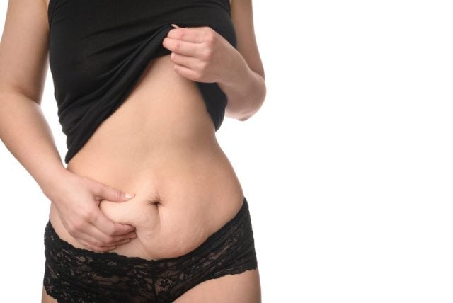 Woman holds extra belly skin before a mommy makeover