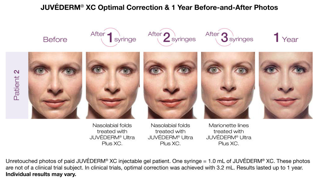 Juvéderm XC Patient Before After San Diego, CA