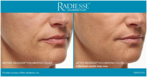 Radiesse Injection Before After San diego, CA