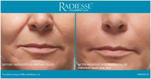 Radiesse Patient San diego, CA