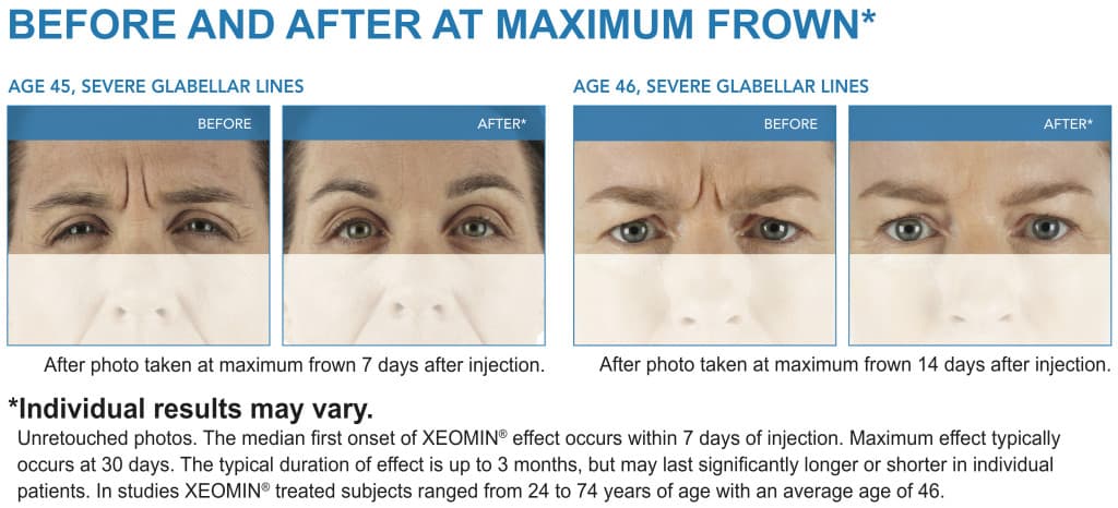 XEOMIN Wrinkle Removal Patient