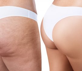 QWO Before & After Photos of the Buttocks