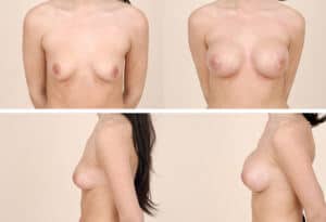 Amman Before and After Breast Implants