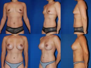 Mommy Makeover - combined tummy tuck and breast augmentation