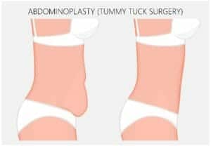 Is a Tummy Tuck Permanent?
