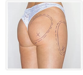 Brazilian Butt Lift Procedure? Here Are the Factors To Consider, Dr. Joshua  Greenwald