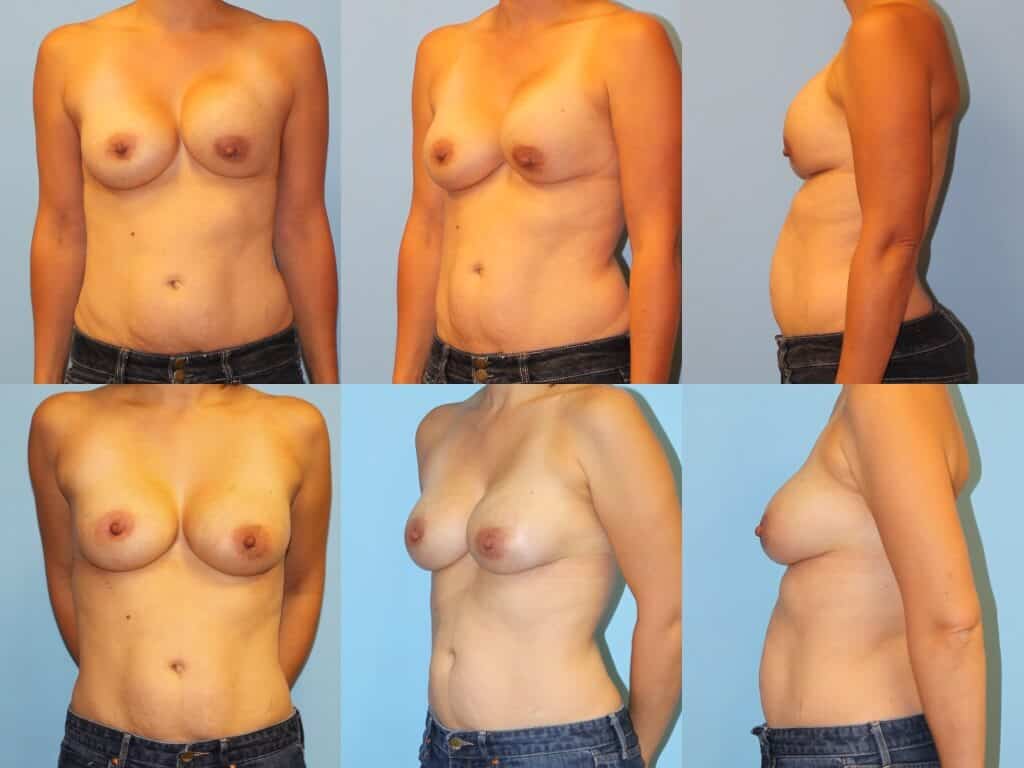 Before & after breast augmentation complications surgery