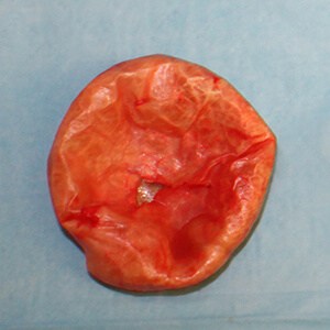 Removal of encapsulated implant