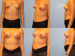 Before & after breast correction Westchester County