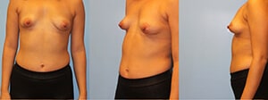 Tubular breast correction New York City