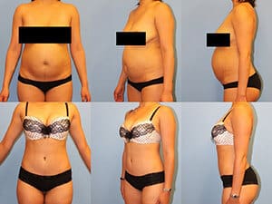 drainless tummy tuck before and after in Alphabet City Manhattan NYC