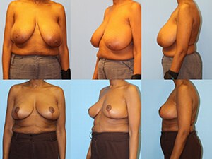 Before & after breast reduction surgery
