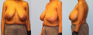 Breast reduction patient