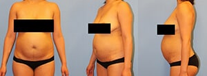 Abdominoplastyka Westchester County