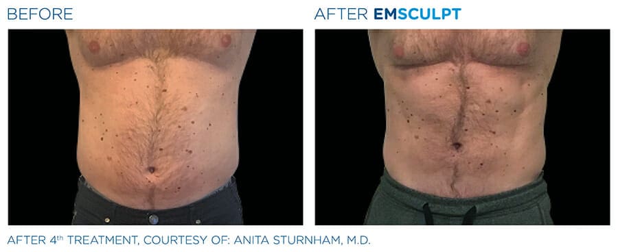 EmSculpt: A Non-Invasive Body Contouring Procedure In New York City