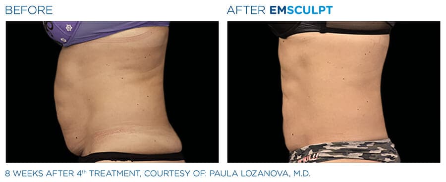 Before & after Emsculpt patient