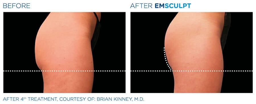 Body slimming before & after Westchester County