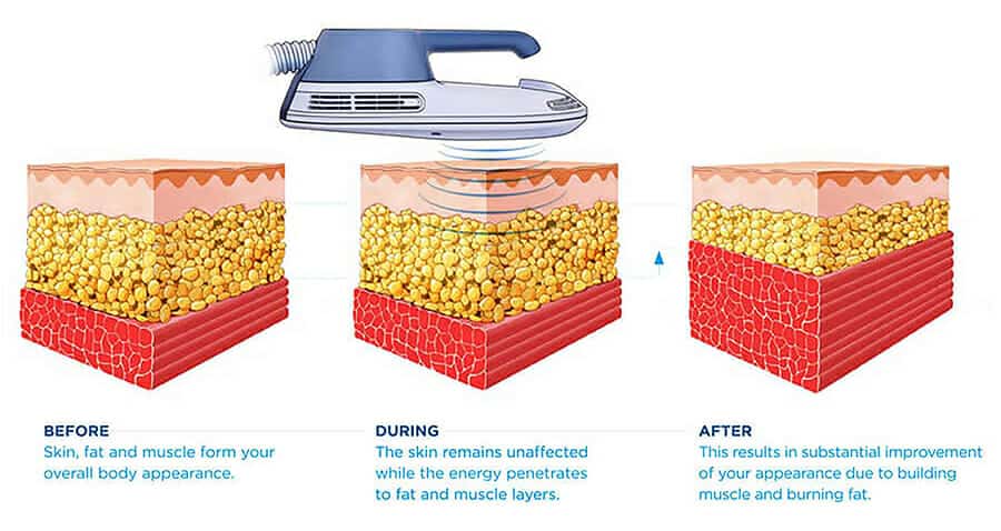 EmSculpt Body Slimming in New York City & Westchester County