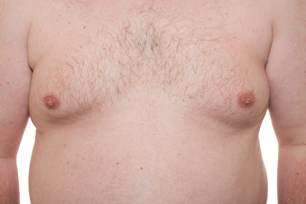 Nonsurgical gynecomastia in New York City