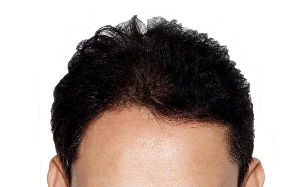 Hair restoration in New York City