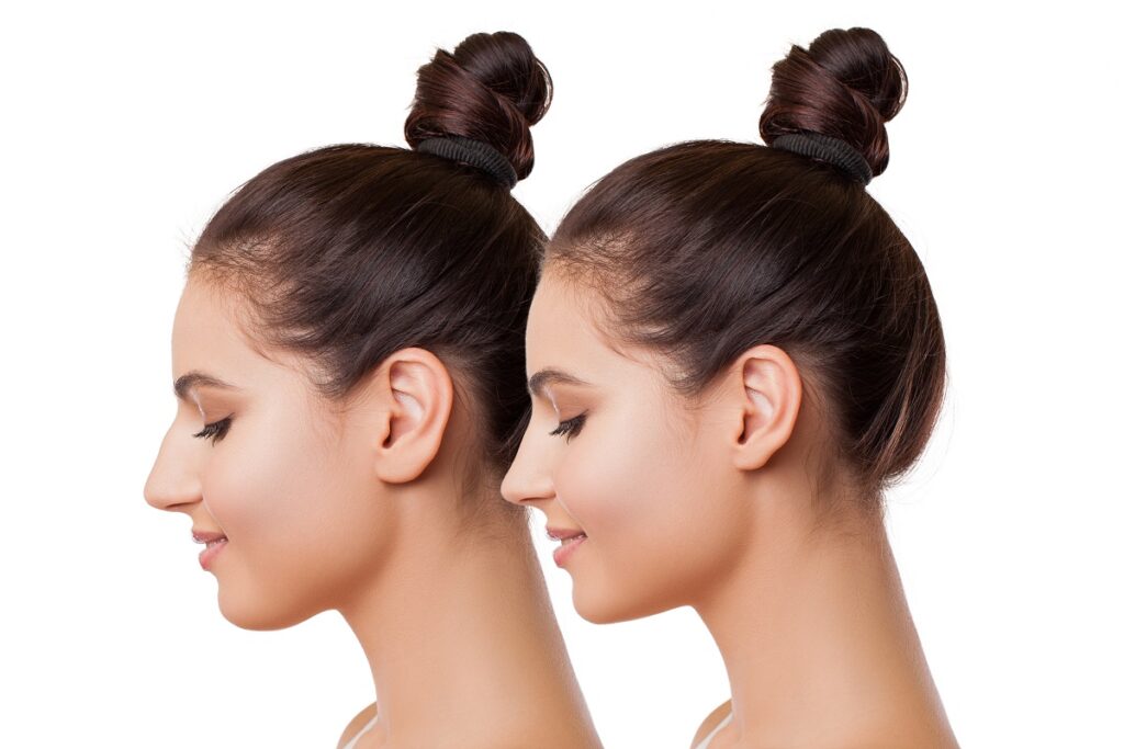 Rhinoplasty procedure New York City, NY