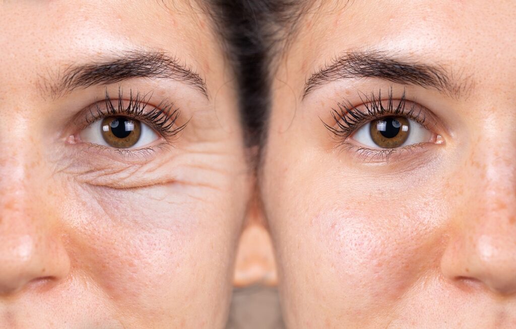 Blepharoplasty Specialist Manhattan, NY