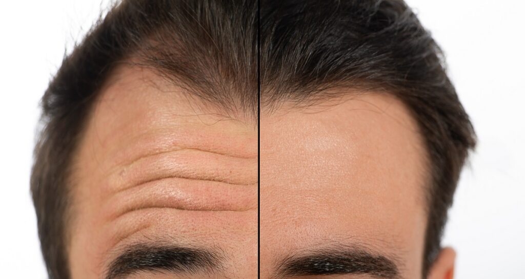 How to Raise Forehead Skin With a Brow Lift Greenwald Plastic Surgery